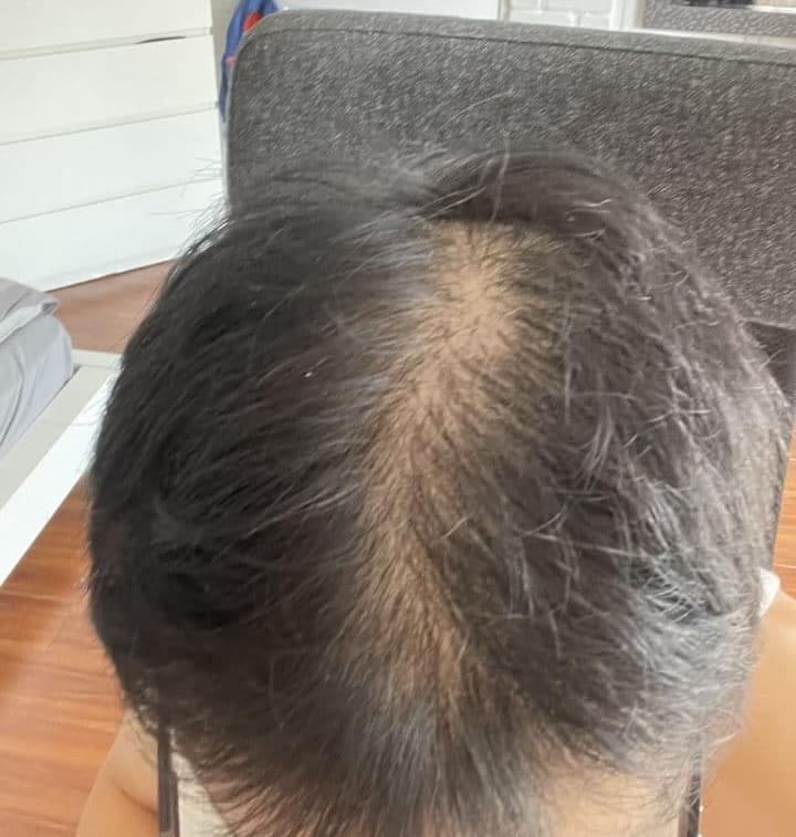 man after hair loss treatment with thinning hair